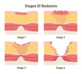 Bedsore stages set. Pressure sores areas on human body parts. Pressure