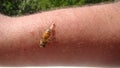 Bee: apis mellifera. treatment by honey bee sting. closeup honey bee stinging a hand. close up bee worker. insects, insect, animal Royalty Free Stock Photo