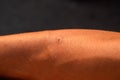 Bee sting. Bee sting in human skin. consequences of stinging with bee venom Royalty Free Stock Photo