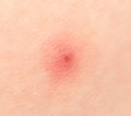 Bee sting on the skin. macro Royalty Free Stock Photo