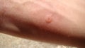 Bee : stung by a bee worker. skin allergy , allergic treatment by honey bee sting closeup honey bee stinging a hand insects, insec