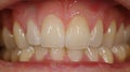 A beforeandafter comparison image of a patients gum line showing the significant improvement from a deep cleaning and Royalty Free Stock Photo