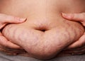 Belly with stretch marks Royalty Free Stock Photo