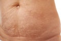 Belly of a 40 year old woman with postpartum stretch marks close up