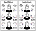 benign paroxysmal positional vertigo canalolithiasis cupulolithiasis Illustration