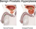 Benign Prostatic Hyperplasia Royalty Free Stock Photo