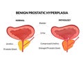 Benign prostatic hyperplasia Royalty Free Stock Photo