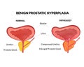 Benign prostatic hyperplasia