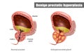 Benign prostatic hyperplasia BPH