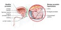 Benign prostatic hyperplasia BPH, enlarged prostate with bladder, urethra and seminal vesicle, medical illustration