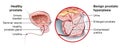 Benign prostatic hyperplasia BPH, enlarged prostate with bladder, urethra and seminal vesicle, medical illustration