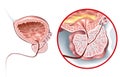 Benign prostatic hyperplasia BPH, enlarged prostate with bladder, urethra and seminal vesicle, medical illustration