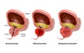 Benign Prostatic hyperplasia