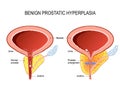 Benign prostatic hyperplasia BPH. prostate enlargement Royalty Free Stock Photo
