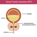 Benign Prostatic Hyperplasia (BPH) , vector Royalty Free Stock Photo