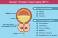 Benign Prostatic Hyperplasia (BPH) , vector Royalty Free Stock Photo