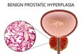 Benign prostatic hyperplasia