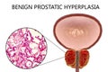 Benign prostatic hyperplasia