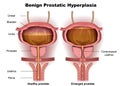 Benign prostatic hyperplasia 3d medical illustration