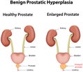 Benign Prostatic Hyperplasia Royalty Free Stock Photo