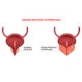 Benign prostatic hyperplasia.Editable vector illustration in realistic style Royalty Free Stock Photo