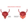 Benign prostatic hyperplasia.Editable vector illustration in realistic style