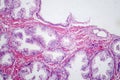 Benign prostatic hyperplasia, light micrograph