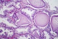 Benign prostatic hyperplasia, light micrograph