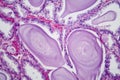 Benign prostatic hyperplasia, light micrograph