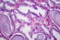 Benign prostatic hyperplasia, light micrograph