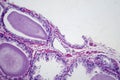 Benign prostatic hyperplasia, light micrograph