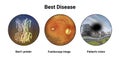 Best disease. Best vitelliform macular dystrophy, illustration