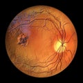 Best vitelliform macular dystrophy, Atrophic stage, retinal atrophy, 3D illustration