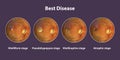 Best vitelliform macular dystrophy stages, scientific illustration
