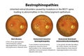 Bestrophinopathies, inherited retinal disorders caused by mutations in the BEST1 gene, illustration