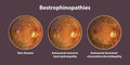 Bestrophinopathies, inherited retinal disorders caused by mutations in the BEST1 gene, illustration