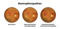 Bestrophinopathies, inherited retinal disorders caused by mutations in the BEST1 gene, illustration