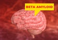 Beta Amyloids are peptides with 36-43 amino acids and the main constituent of the plaques observed in the brains of patients with