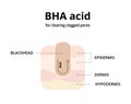 BHA acid for cleaning clogged pores Royalty Free Stock Photo