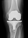 Bicompartmental knee prosthesis xray Royalty Free Stock Photo