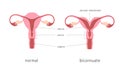 Bicornuate and normal human uterus structure. Uterine deep septum as a congenital uterine malformation. Anatomy chart.