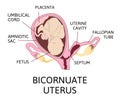 Bicornuate uterus and pregnancy. One uterine with fetus, child. Second uterine cavity is empty and separeted with septum