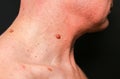 Big birthmark on the man`s skin. Medical health photo. Papillomas on the neck