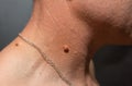 Big birthmark on the man` skin. Medical health papilloma photo