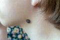 Big Birthmark on the neck of a child. Mole with hairs