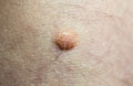 Big birthmark on skin. Medical health photo. Papillomas on human body