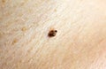 Big birthmark on skin. Medical health photo. Papillomas on human body