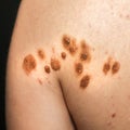 Big birthmarks and freckles on the girl`s skin. Medical health photo of back. Woman`s oily skin with problems acne