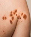 Big birthmarks and freckles on the girl`s skin. Medical health photo of back. Woman`s oily skin with problems acne