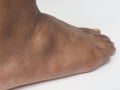 Big ganglion cysts on the foot.